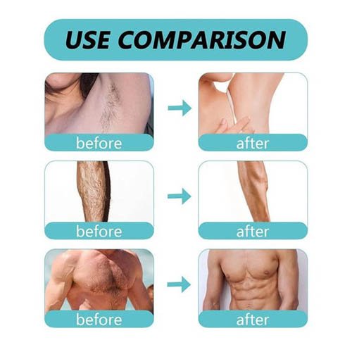 Before and after hair removal comparisons on armpit, leg, and chest showing smooth skin results