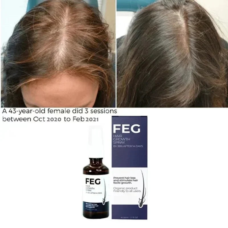 Before and after photos showing hair regrowth on a 43-year-old female using FEG hair growth spray with product bottle and packaging