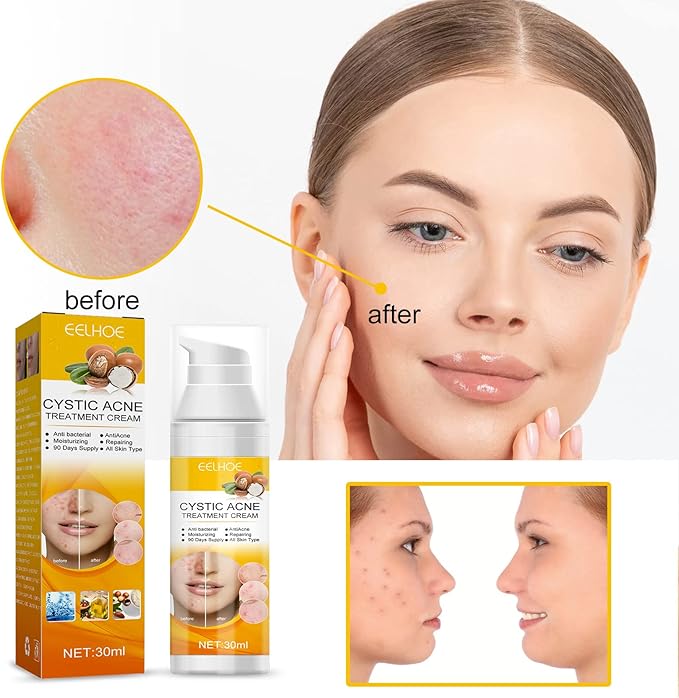 Eelhoe cystic acne treatment cream with before and after results on woman’s clear skin, anti-bacterial and moisturizing