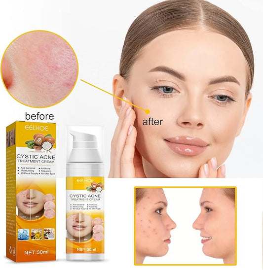 Eelhoe cystic acne treatment cream with before and after results on woman’s clear skin, anti-bacterial and moisturizing