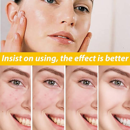 Woman applying skincare cream with progressive improvement in cystic acne and clearer skin over time