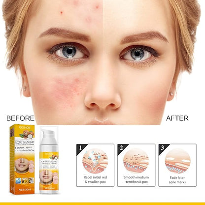 Eelhoe cystic acne cream before and after face showing reduced redness and clear skin, acne treatment steps